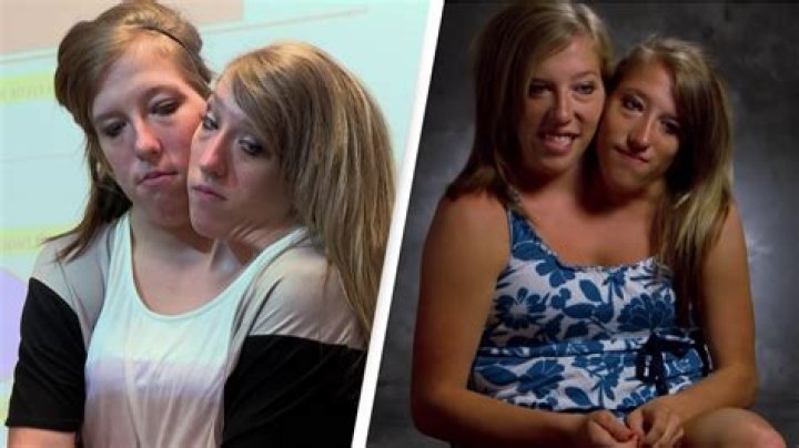 Abby And Brittany's Separated Fate